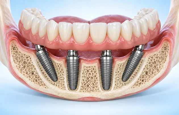 Cutaway of a lower jaw model showing four implants in the bone, the two at the back tilted, beneath a fixed arch of teeth