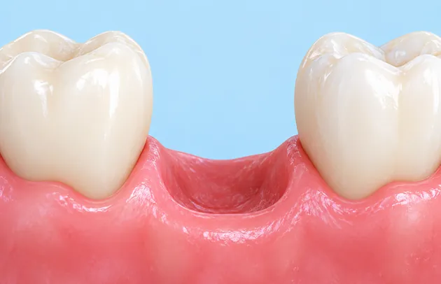 Model of the lower jaw showing the gap left by a missing molar between two natural teeth