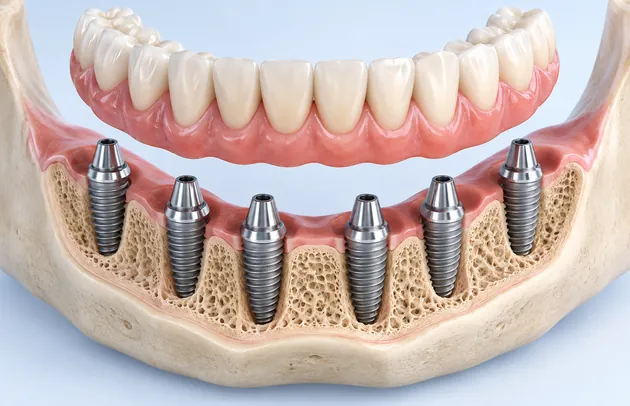 Cutaway of a jaw model showing six implants set in the bone with a bridge lifted above them